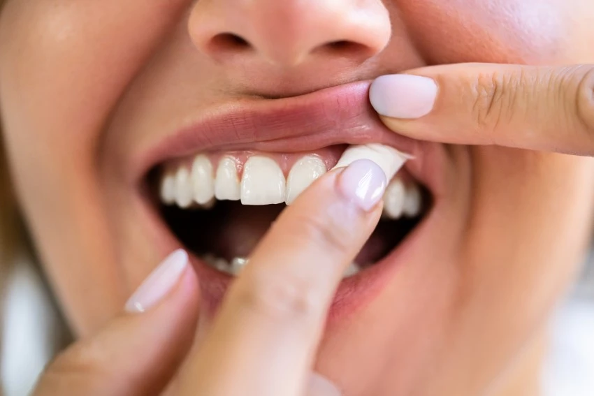 Woman inserting nicotine pouch in to her gums